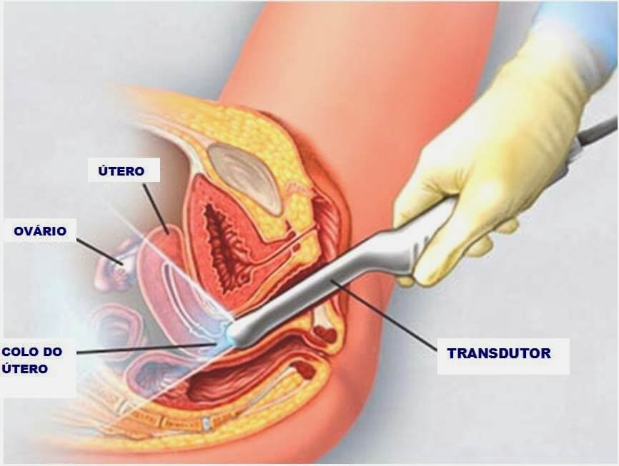 Ultrassonografia Transvaginal Em São Paulo Sp Faça O Exame Na Frade 3762